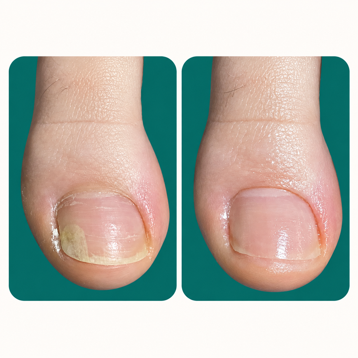 Nega za nohtno posteljico - ONYGEN 20ML